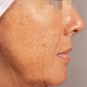 Aged skin Antes GREEN PEEL Classic