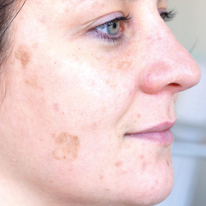 Pigment spots Depois a GREEN PEEL herbal peeling