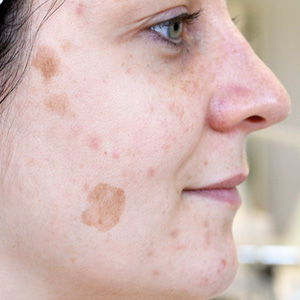 Pigment spots Antes a GREEN PEEL herbal peeling